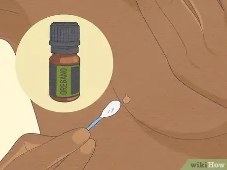 Image titled Get Rid of Skin Tags Step 6