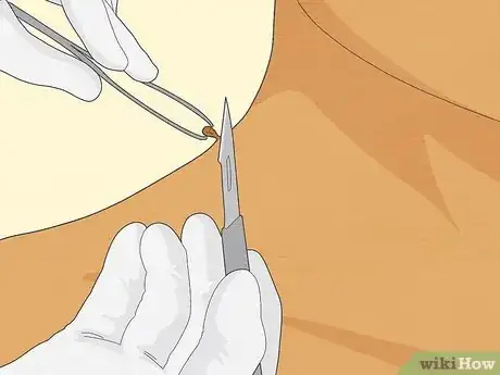 Image titled Get Rid of Skin Tags Step 14