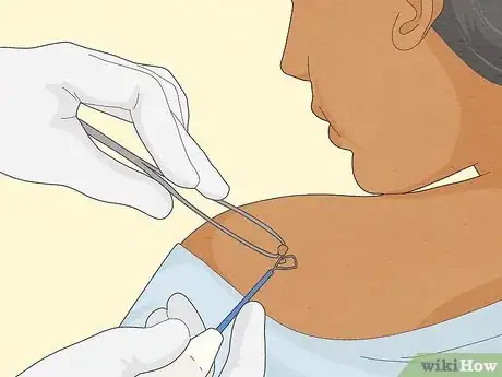 Image titled Get Rid of Skin Tags Step 16