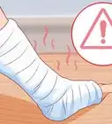 Scratch Under Your Cast