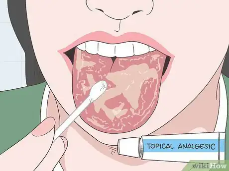 Image titled Treat Geographic Tongue Step 2