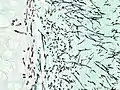 Pulmonary invasive aspergillosis in a person with interstitial pneumonia (autopsy material), using Grocott's methenamine silver stain