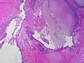 Aspect microscopique. La lumière bronchique est ici occupée par un aspergillome.