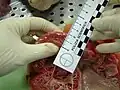 Hypertrophie ventriculaire gauche avec épaississement du muscle cardiaque.