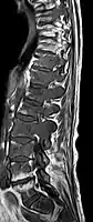 IRM sagittal natif avec pondération T1. On voit clairement l’extension jusqu'aux lames vertébrales.