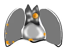 Dessin représentant un thymome stade IV.