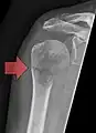 Fracture pathologique de l'humérus sur une métastase de carcinome du rein