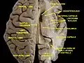 Vue supérieure d'une coupe horizontale d'une dissection profonde des ventricules du cerveau et des ganglions de la base.