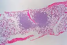 Sur un étalement de moelle osseuse on observe deux volumineuse concentration de lymphocytes en amas