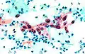 Cellule d'un cancer épidermoïde dans un frottis.