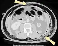 Image illustrative de l’article Emphysème sous-cutané