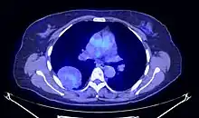 Coupe axiale de TEP thoracique.